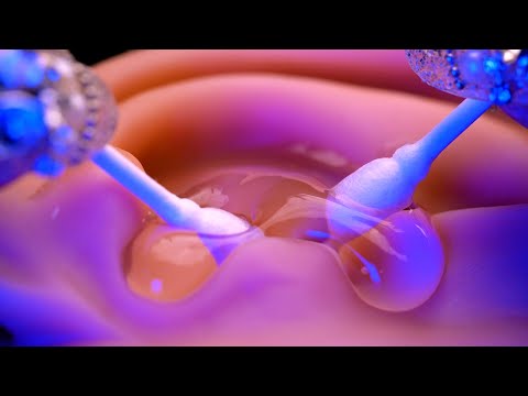Видео: [ASMR] Гелевые ватные палочки с обоими ушами, полностью погруженными в воду Чистка ушей (ACMP / Sub)