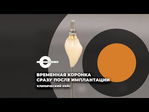 Видео: Временная коронка сразу после имплантации