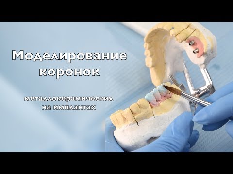 Видео: Моделирование металлокерамических коронок  ivoclar,  имплантация зубов  влог