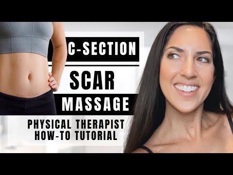 Видео: Как делать массаж рубца после кесарева сечения | Физиотерапевт | Избавление от мешка и рубцовой т...