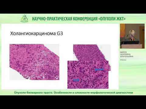 Видео: Опухоли билиарного тракта  Особенности и сложности морфологической диагностики