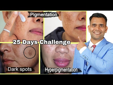 Видео: 25-дневный челлендж: избавьтесь от пигментации и мелазмы естественным путем