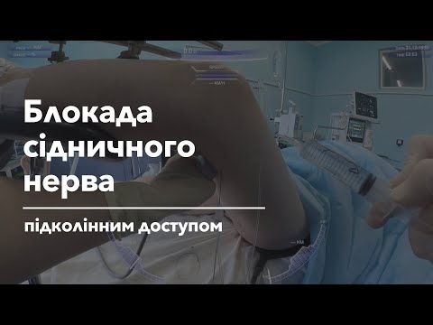 Видео: Блокада сідничного нерва підколінним доступом | Popliteal Sciatic Nerve Block
