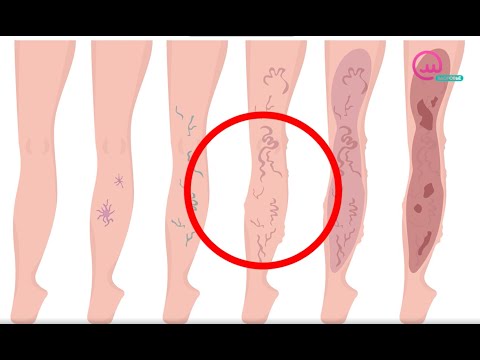 Видео: Доктор знает! Варикоз. Варикозное расширение вен | Телеканал "Открытый мир. Здоровье"