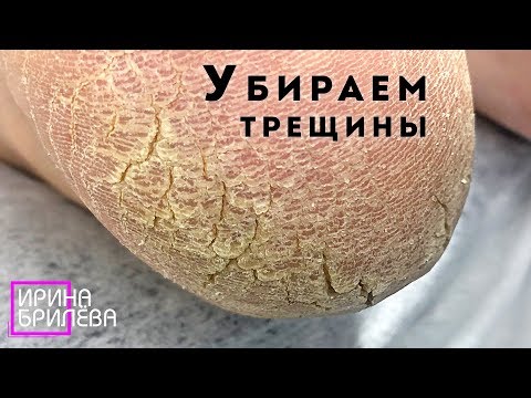 Видео: ПЕДИКЮР 🌸 Борьба с трещинами 🌸 Уход за ногами