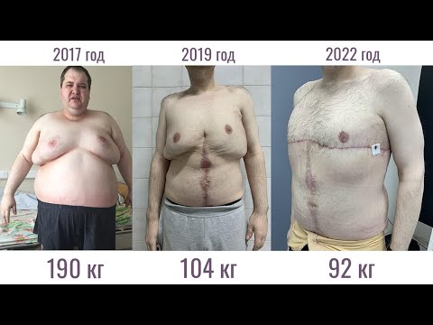 Видео: Минус 100 кг, провисшая кожа на всех частях тела