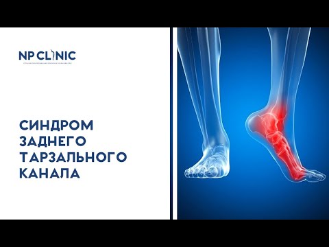 Видео: Синдром заднего тарзального канала