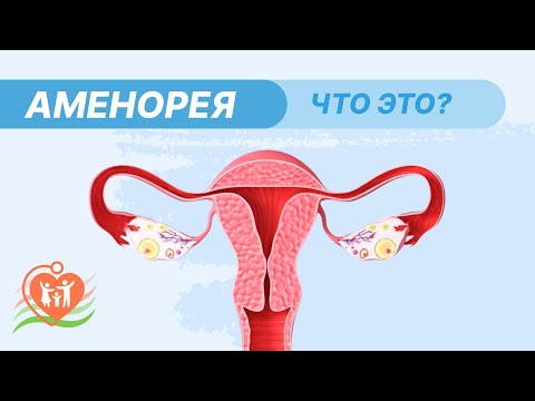 Видео: 🔻  Аменорея / Почему исчезли менструации?