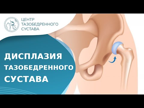 Видео: ❓ Что такое дисплазия тазобедренного сустава? Дисплазия тазобедренного сустава что это. 18+