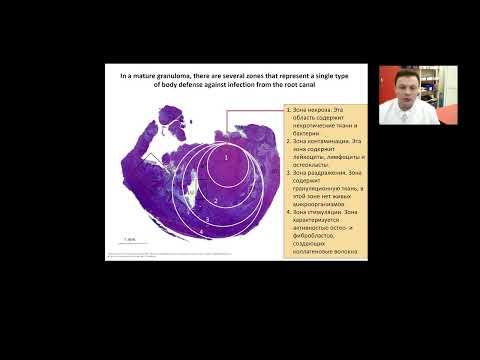 Видео: Кисты челюстей, гингивит, парадонтит
