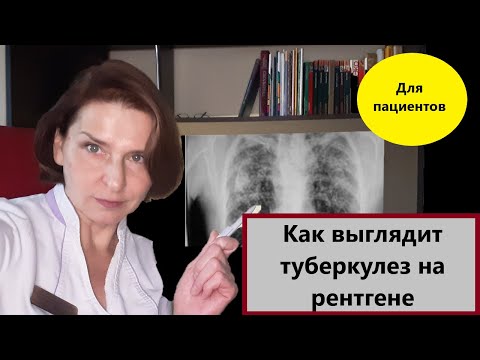 Видео: Рентген туберкулеза