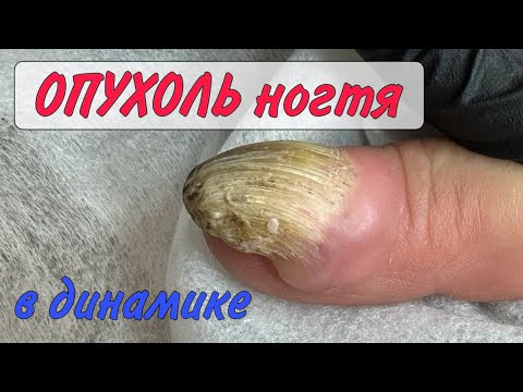 Видео: Опухоль на пальце/онихоматрикома/сложный случай