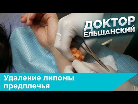 Видео: Удаление липомы предплечья