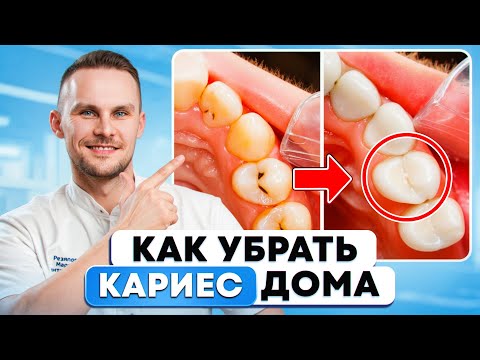 Видео: Как избавиться от КАРИЕСА дома? – эффективный метод РЕМИНЕРАЛИЗАЦИЯ ЭМАЛИ
