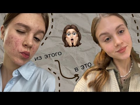 Видео: ТЯЖЕЛАЯ СТАДИЯ АКНЕ/Моя история💆🏼‍♀️🪩