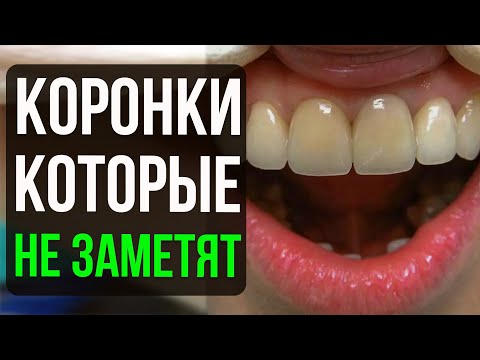 Видео: Какие коронки выбрать на передние зубы? 🦷 Советы стоматолога для идеальной улыбки!