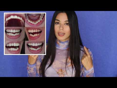 Видео: БРЕКЕТЫ МОЯ ИСТОРИЯ