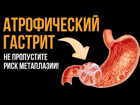 Видео: Атрофический гастрит с метаплазией в желудке: когда есть риск и как защитить слизистую желудка?