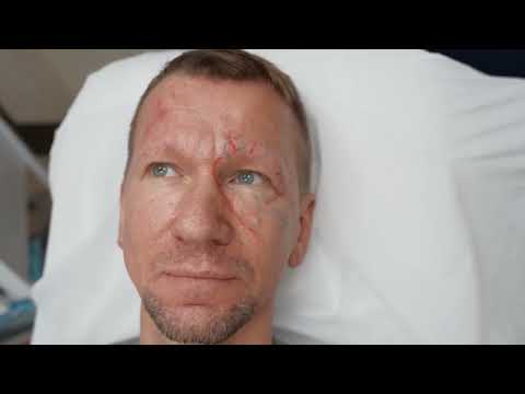 Видео: Коррекция верхней трети лица филлером Neauvia Stimulate