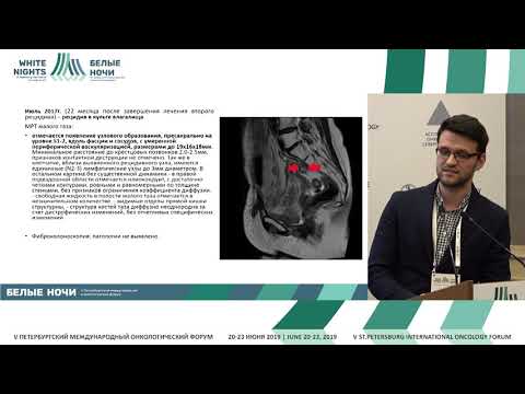 Видео: Мнение химиотерапевта. Рак шейки матки (Тюляндина А.С.), Дискуссия