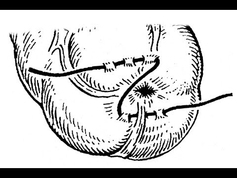 Видео: Z образный шов. Техника наложения Z образного шва в лапароскопии.