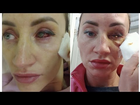 Видео: Пациентке удалили глаз после лазерной коррекции зрения в клинике "Смотри" в Оренбурге