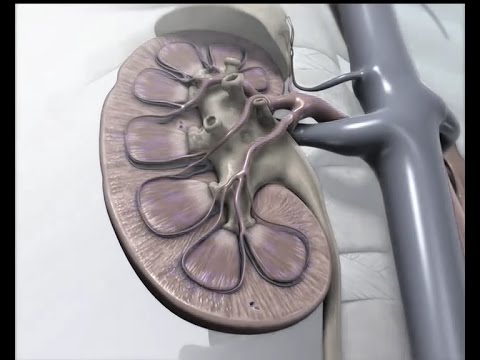 Видео: Как определить есть ли у вас камни в почках