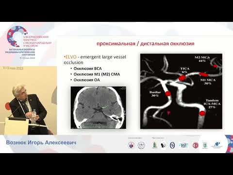 Видео: Злокачественный ишемический инсульт СМА Вознюк И.А.