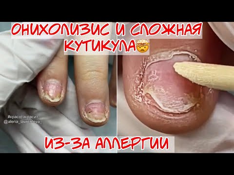 Видео: Аллергия на гель лак 🥴 Онихолизис 😱Сложная кутикула