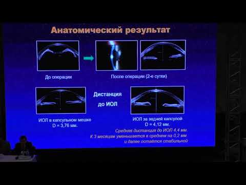 Видео: Хирургия увеальной катаракты