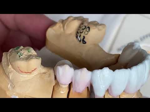 Видео: Как сделать коронку и мост из 8-секционного фарфора из диоксида циркония Vita