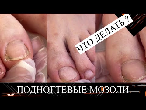 Видео: Педикюр 🦶ПОДНОГТЕВЫЕ Мозоли / Впервые на педикюре
