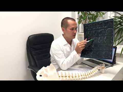 Видео: С4-С5 межпозвоночная грыжа (протрузия диска с4-5 ) лечение межпозвоночной грыжи шейного отдела.