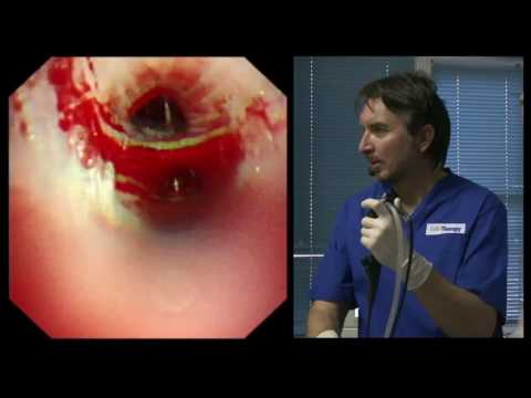 Видео: 12Live Aleš Rozman Сивокозов ИВ pEBUS EBUS TBNA ЭБУС ТИП