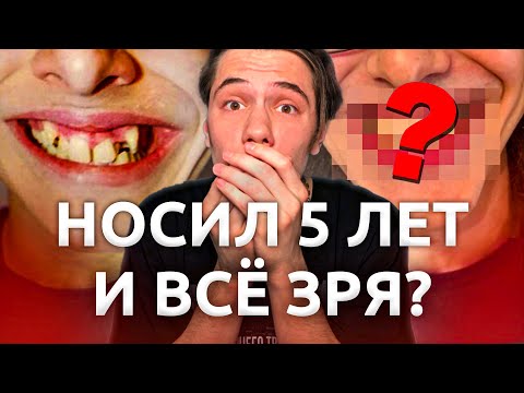 Видео: Носил брекеты 5 лет. Почему так долго? И какого это было?