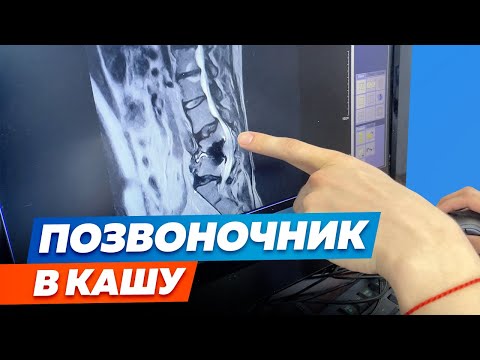 Видео: Можно ли полностью ВЫЛЕЧИТЬ спину ПОСЛЕ ПЕРЕЛОМА 3-х позвонков?