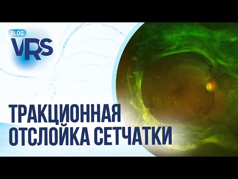 Видео: Сахарный диабет / Диабетическая ретинопатия / Тракционная отслойка сетчатки / Макулярный разрыв