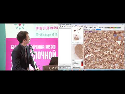 Видео: Диагностические сложности: редкие опухоли РМЖ. Клинический случай 2