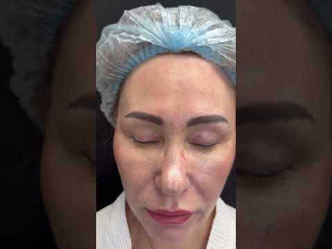 Видео: Осложнения после верхней блефаропластики: несмыкание век и синдром сухого глаза