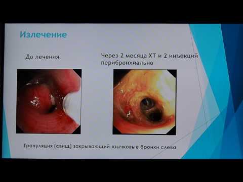 Видео: 11 Шабалина ИЮ Бронхоскопия в диагностике туберкулеза бронхов