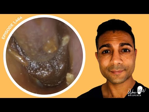 Видео: 1464 — Новое дыхание жизни: удаление ушной серы для 94-летнего слепого, прикованного к инвалидной...