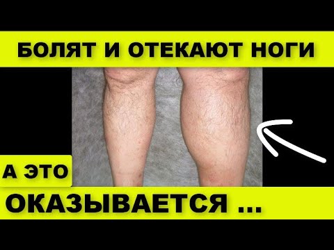 Видео: ОПАСНЫЕ признаки ТРОМБА В СОСУДАХ !