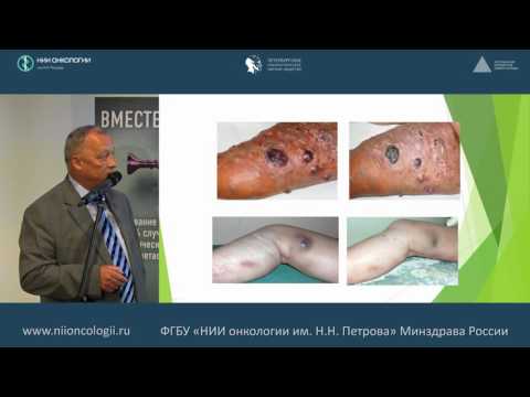 Видео: Роль и место регионарной перфузии в лечении местно-распространенной меланомы кожи.