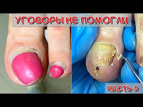 Видео: Онихолизис ногтей на ногах / Кератоз ногтей (Часть 2)