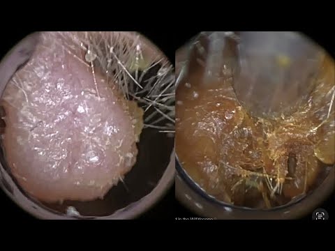 Видео: 128 - Комплексное удаление ушной серы у пациента с полипом уха с использованием WAXscope®️ и iCLE...