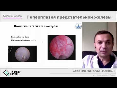 Видео: Лазерная энуклеация простаты