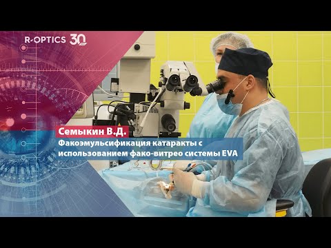 Видео: Факоэмульсификация катаракты с использованием фако-витрео системы EVA (Семыкин В.Д.)