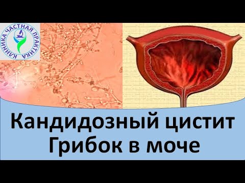 Видео: Кандидозный цистит.  Грибок в моче.