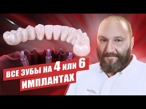 Видео: 🇺🇦 Имплантация «все на 4 и 6» имплантах — в чем отличие