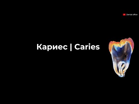 Видео: Кариес | Современные представления о кариесе | Откуда берется кариес ? Dental caries